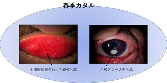 結膜炎の治療に抗生物質が必要なのは誰ですか?