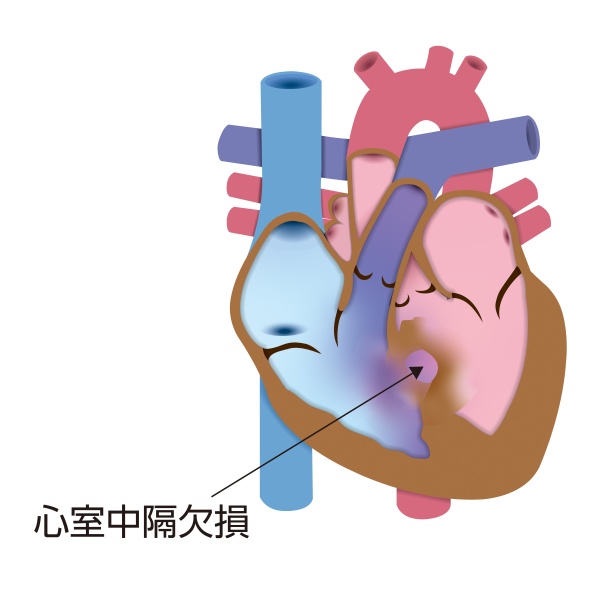 心室中隔欠損症（VSD）の模式図。左右の心室を隔てる心室中隔の膜様部に大きな欠損孔があり、左心室から右心室へ血液が流れる状態を示している