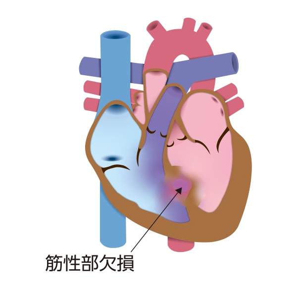筋性部心室中隔欠損症の模式図。心室中隔の筋肉部分に欠損孔が生じ、左心室から右心室への異常な血液の短絡がみられる状態を示している