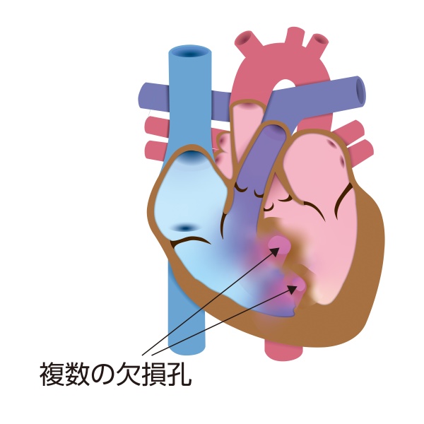 多発性心室中隔欠損症の模式図。心室中隔に複数の欠損孔が存在し、左心室から右心室へ複数箇所で血液が流れる状態を示している