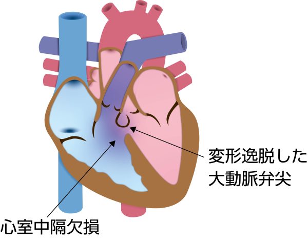 心室中隔欠損症（VSD）に伴う大動脈弁逸脱の解剖図。欠損孔によって支えを失った大動脈弁尖が心室中隔欠損部へ突出し、大動脈弁逆流を生じる状態を示している