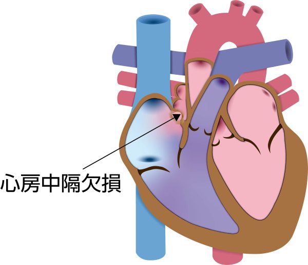 先天性心疾患である心房中隔欠損症（ASD）の解剖図。心房中隔の穴を通じて左心房から右心房へ血液が短絡し、右心系や肺循環への負荷が増加する様子を示している
