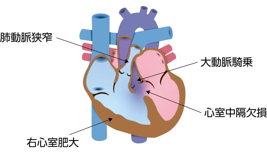 ファロー四徴症（TOF）の模式図。肺動脈狭窄、心室中隔欠損、大動脈騎乗、右心室肥大の4つの特徴的な異常を示している