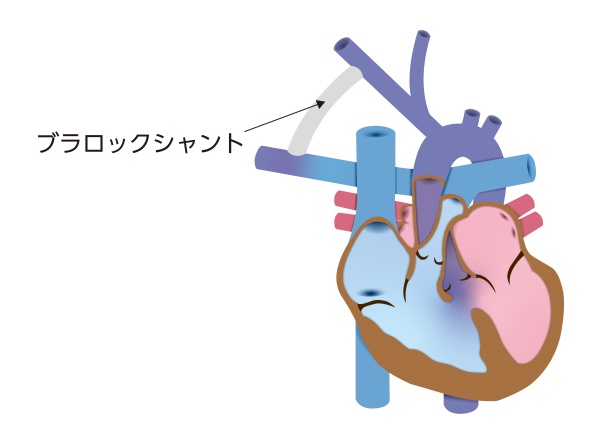 ファロー四徴症に対するブラロックシャント手術の模式図。体循環の動脈と肺動脈を人工血管で接続し、肺への血流を増やす治療を示している