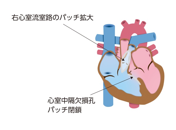 ファロー四徴症の根治手術を示す模式図。心室中隔欠損孔をパッチで閉鎖し、狭窄した右心室流出路と肺動脈を拡大して血流を改善した状態を示している