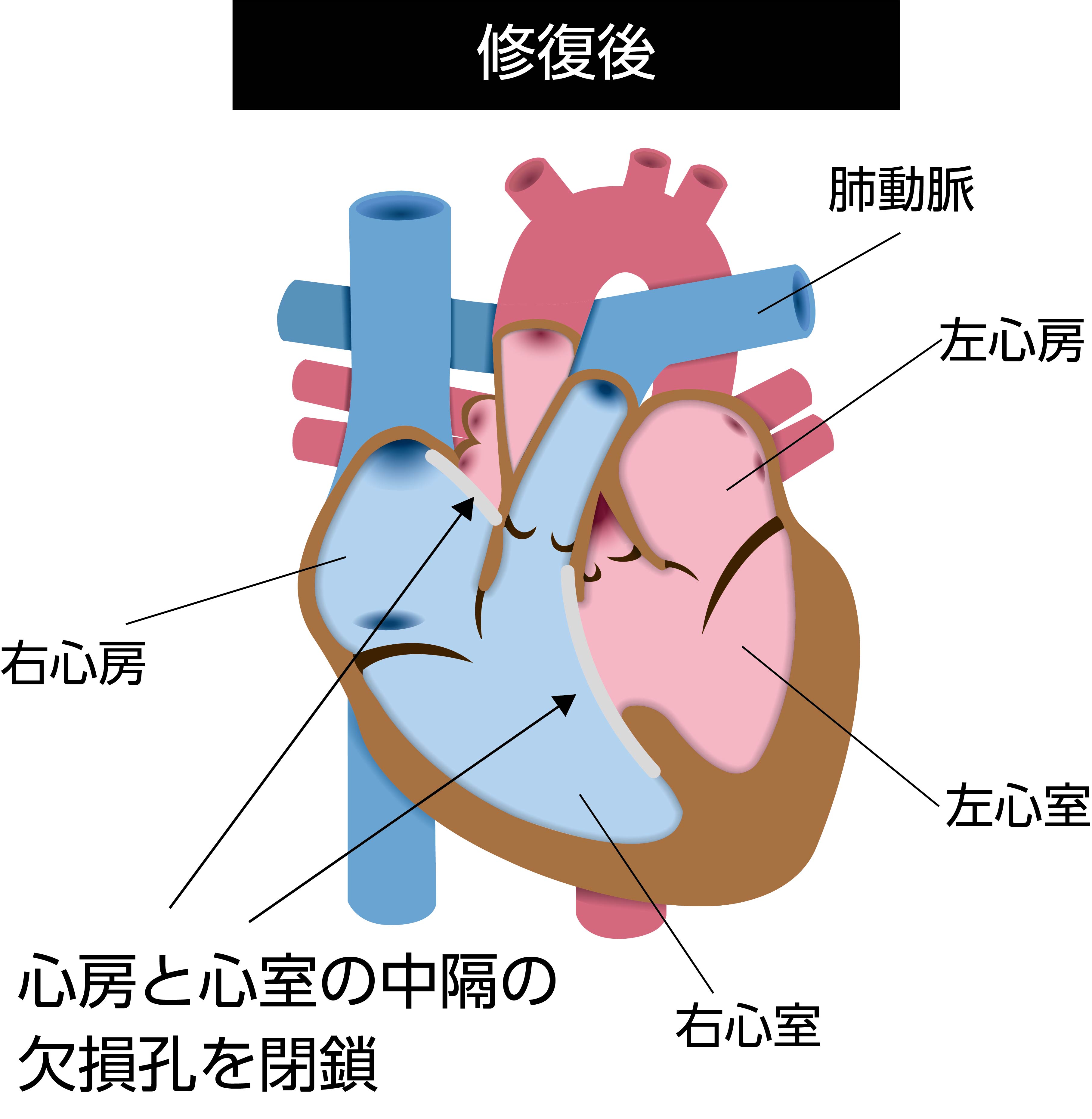 完全型房室中隔欠損症の手術後を示す模式図。パッチにより心房中隔欠損と心室中隔欠損を閉鎖し、共通房室弁を左右の房室弁へ再建した状態を示している