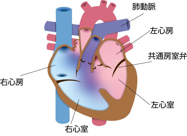 完全型房室中隔欠損症（AVSD）の模式図。心房中隔と心室中隔に連続した大きな欠損があり、左右の心房・心室で血液が交通し、共通房室弁を認める状態を示している
