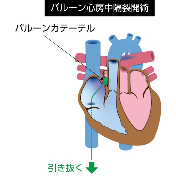 完全大血管転位症に対するバルーン心房中隔裂開術(BAS)の模式図。バルーンカテーテルで心房中隔を拡大し、酸素化血液と静脈血の混合を促す治療を示している