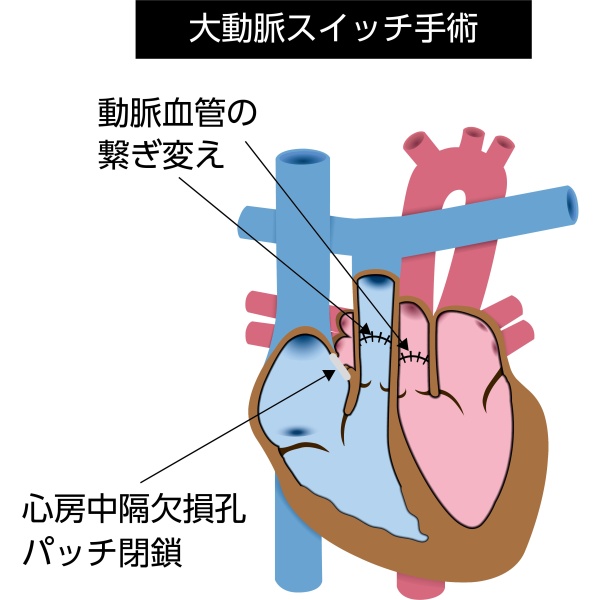 完全大血管転位症に対する大動脈スイッチ手術の模式図。大動脈と肺動脈を正常な位置に付け替え、冠動脈を移植して正常な血液循環を再建する手術を示している