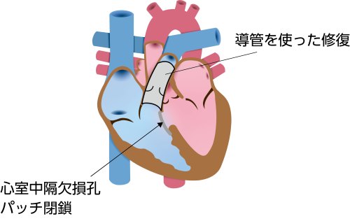 総動脈幹症に対する修復手術の模式図。心室中隔欠損孔をパッチで閉鎖し、肺動脈を総動脈幹から分離して右心室流出路を再建した状態を示している