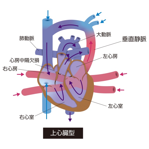 総肺静脈還流異常症(TAPVD)の上心臓型模式図。肺静脈が左心房ではなく垂直静脈を介して上大静脈へ接続している状態を示している