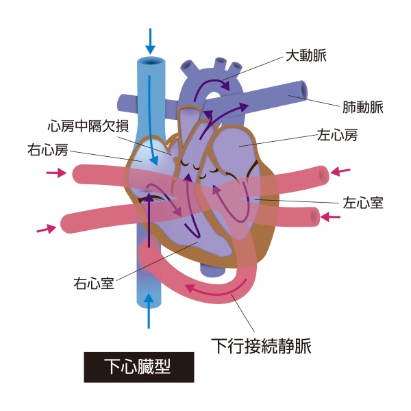 総肺静脈還流異常症(TAPVD)の下心臓型模式図。肺静脈が左心房ではなく下行接続静脈を介して下大静脈系へ接続している状態を示している