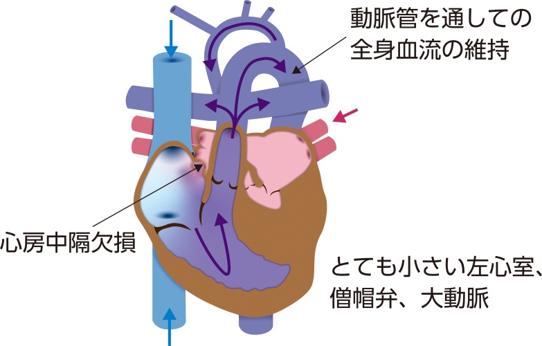 左心低形成症候群（HLHS）の模式図。左心室、僧帽弁、大動脈が著しく小さく、動脈管を介して全身への血流が維持されている状態を示している