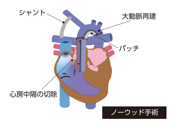 左心低形成症候群に対するノーウッド手術の模式図。肺動脈を利用して大動脈を再建し、シャントによって肺血流を確保した状態を示している