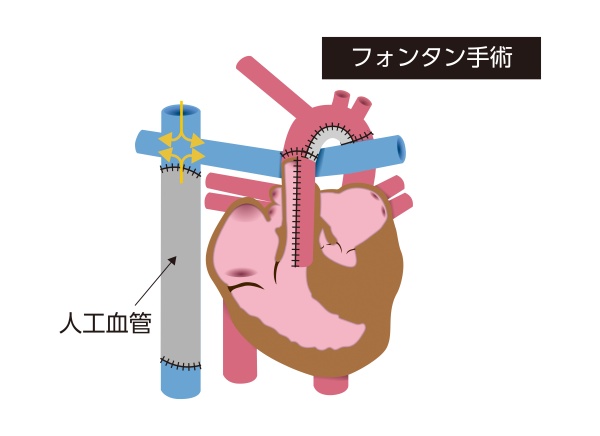 左心低形成症候群に対するフォンタン手術の模式図。人工血管を用いて体静脈血を肺動脈へ直接流し、単心室循環を完成させた状態を示している