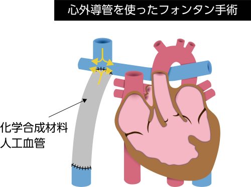 フォンタン手術に用いる心外導管法の説明図。化学合成材料で作られた人工血管によって下大静脈と肺動脈を接続し、静脈血を肺へ流す経路を示している