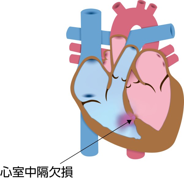先天性心疾患である心室中隔欠損症（VSD）の解剖図。心室中隔の穴を通じて左心室から右心室へ血液が短絡し、特徴的な血流の変化を示している