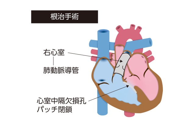 肺動脈閉鎖症・心室中隔欠損症の根治手術を示す模式図。心室中隔欠損孔をパッチで閉鎖し、右心室と肺動脈を導管で再建した状態を示している
