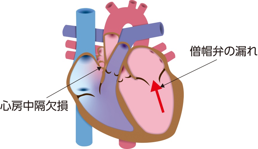 不完全心内膜欠損症の解剖図。心房中隔下部に欠損孔があり、左心房から右心房へ血液が流入するとともに、僧帽弁閉鎖不全を合併した状態を示している