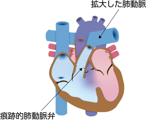 肺動脈弁欠損症の模式図。痕跡的な肺動脈弁と著しく拡大した肺動脈を示し、肺動脈から右心室への逆流が生じる状態を表している