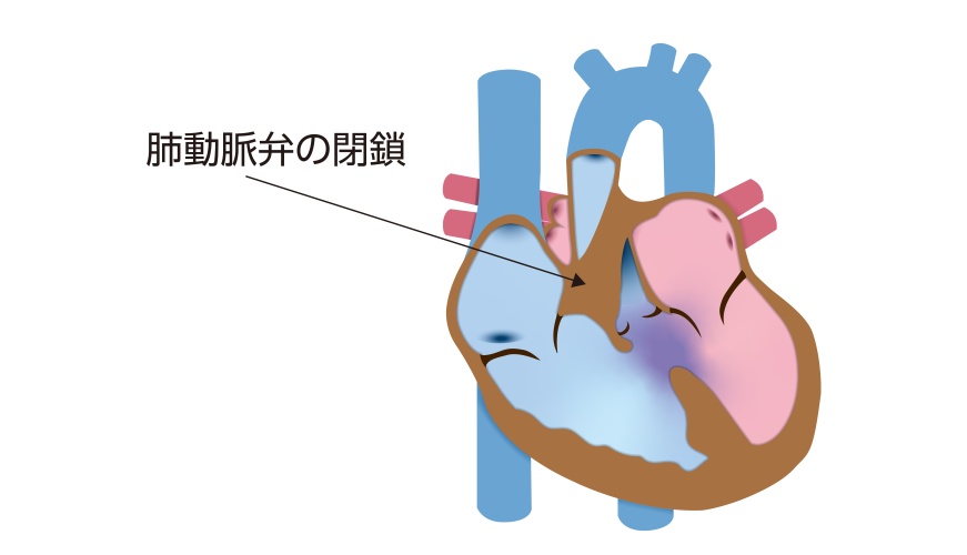 肺動脈閉鎖症・心室中隔欠損症に主要体肺側副動脈（MAPCA）を合併した状態の模式図。肺動脈弁が閉鎖し、発達不良の肺動脈の代わりにMAPCAが肺へ血流を送っている