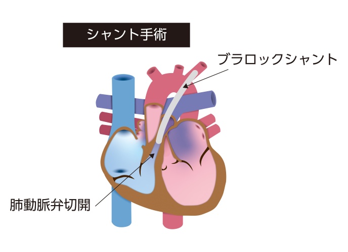 純型肺動脈閉鎖症に対する初期治療の模式図。ブラロックシャント手術により肺血流を確保し、肺動脈弁切開によって右心室から肺動脈への流出路再開を図る治療を示している
