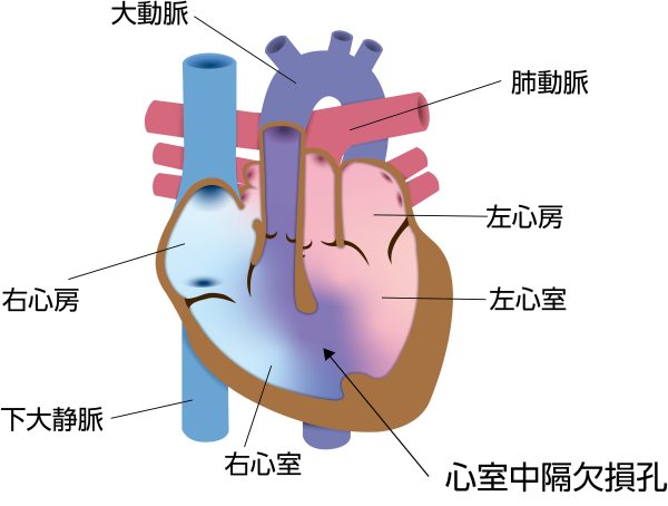 完全大血管転位症（TGA）に心室中隔欠損症（VSD）を合併した模式図。大動脈と肺動脈の位置が入れ替わり、心室中隔欠損孔を介して左右の心室間で血液が混合している状態を示している