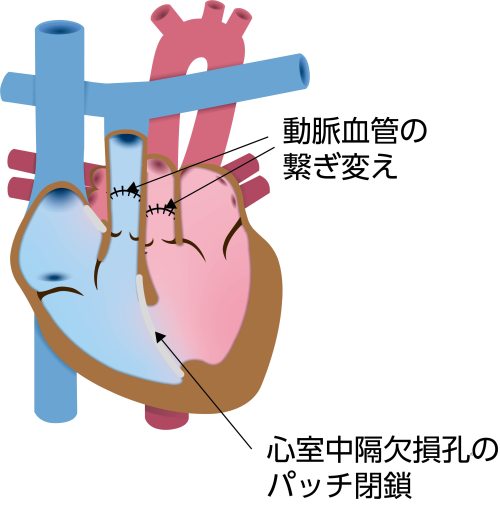 完全大血管転位症と心室中隔欠損症に対する根治手術の模式図。大動脈と肺動脈を正常な位置へ付け替え、心室中隔欠損孔をパッチで閉鎖した状態を示している