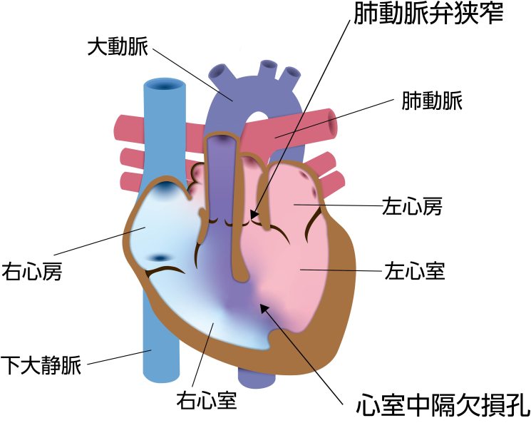 完全大血管転位症（TGA）に心室中隔欠損（VSD）と肺動脈狭窄（PS）を合併した模式図。大動脈と肺動脈の位置異常に加え、心室中隔欠損孔と肺動脈弁狭窄を認める状態を示している