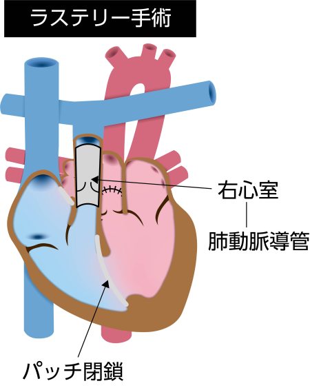 ラステリー手術の模式図。心室中隔欠損を利用して左心室から大動脈への血流経路を作成し、右心室と肺動脈を導管で接続して血流を再建した状態を示している