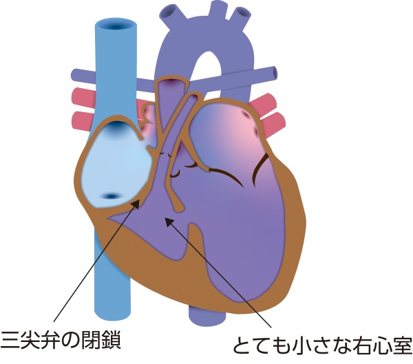 三尖弁閉鎖症（TA）の模式図。右心房と右心室の間の三尖弁が形成されず、低形成右心室を伴う状態を示している