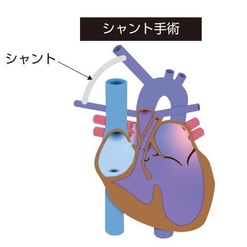 三尖弁閉鎖症に対するシャント手術の模式図。体動脈と肺動脈を接続して肺への血流を確保する治療を示している