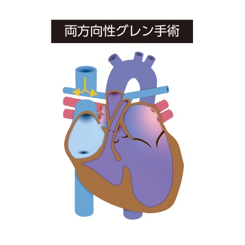 両方向性グレン手術の模式図。上大静脈を肺動脈へ直接接続し、上半身から戻る静脈血を心臓を介さず肺へ流す循環を示している