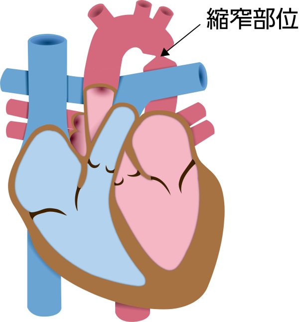 大動脈縮窄症（CoA）の解剖図。左鎖骨下動脈の分岐後に大動脈の狭窄を認め、上半身の血圧上昇と下半身への血流低下を生じる状態を示している