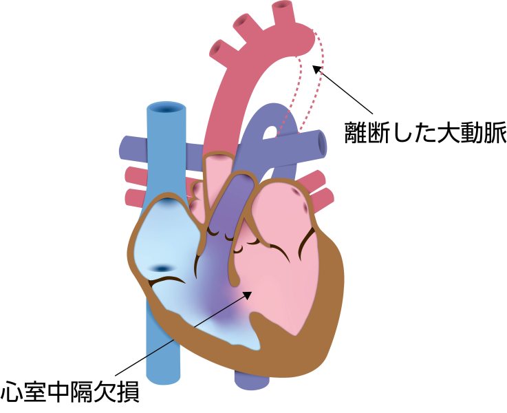 大動脈離断症（IAA）の模式図。大動脈弓が途中で完全に途切れ、心室中隔欠損を伴いながら下半身への血流が障害されている状態を示している その他の行を表示する
