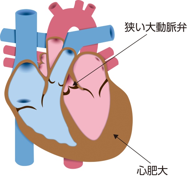 大動脈弁狭窄症（AS）の模式図。狭くなった大動脈弁によって左心室から大動脈への血流が制限され、左心室肥大を生じている状態を示している