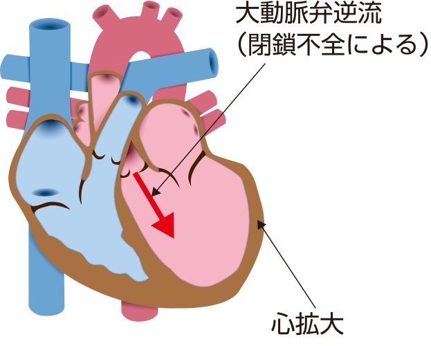 大動脈弁閉鎖不全症（AR）の模式図。大動脈弁が完全に閉じず、大動脈から左心室へ血液が逆流して心拡大を生じている状態を示している