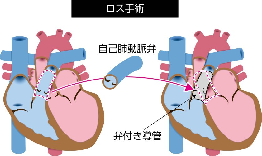 ロス手術の模式図。患者自身の肺動脈弁を大動脈弁の位置へ移植し、肺動脈弁の位置には弁付き導管を再建した状態を示している
