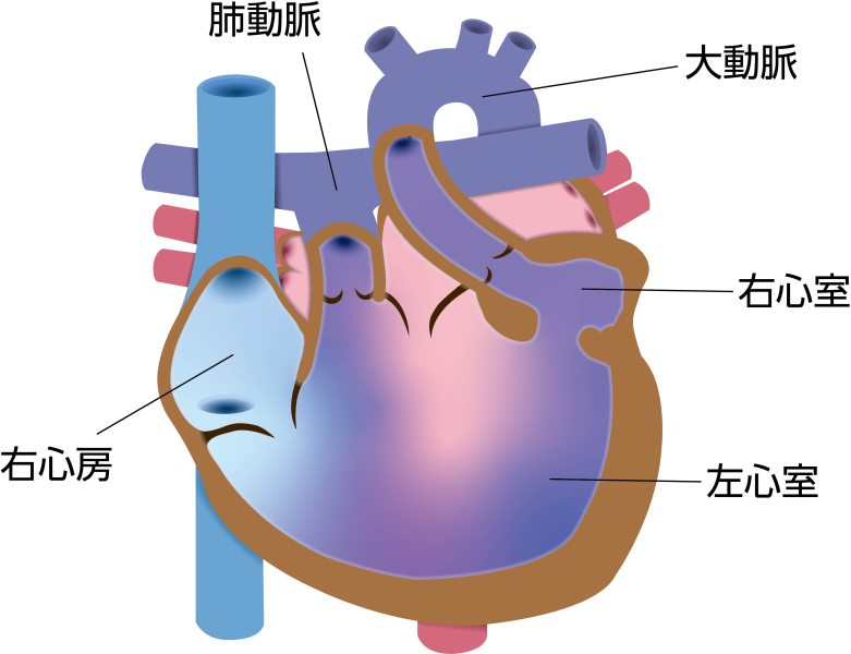 左室性単心室症（DILV）の模式図。左右の心房が一つの左心室につながり、小さな右心室を介して大動脈が起始している状態を示している