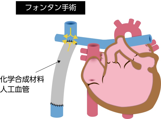 左室性単心室症に対するフォンタン手術の模式図。人工血管を用いて体静脈血を肺動脈へ直接流し、単心室循環を再建した状態を示している
