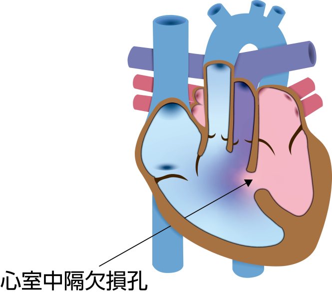 両大血管右室起始症（DORV）の模式図。大動脈と肺動脈の両方が右心室から起始し、左心室の血液が心室中隔欠損孔を通って大血管へ流れる状態を示している