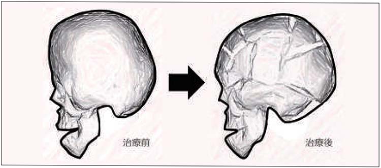頭蓋骨縫合早期癒合症：治療前後のシェーマ画像